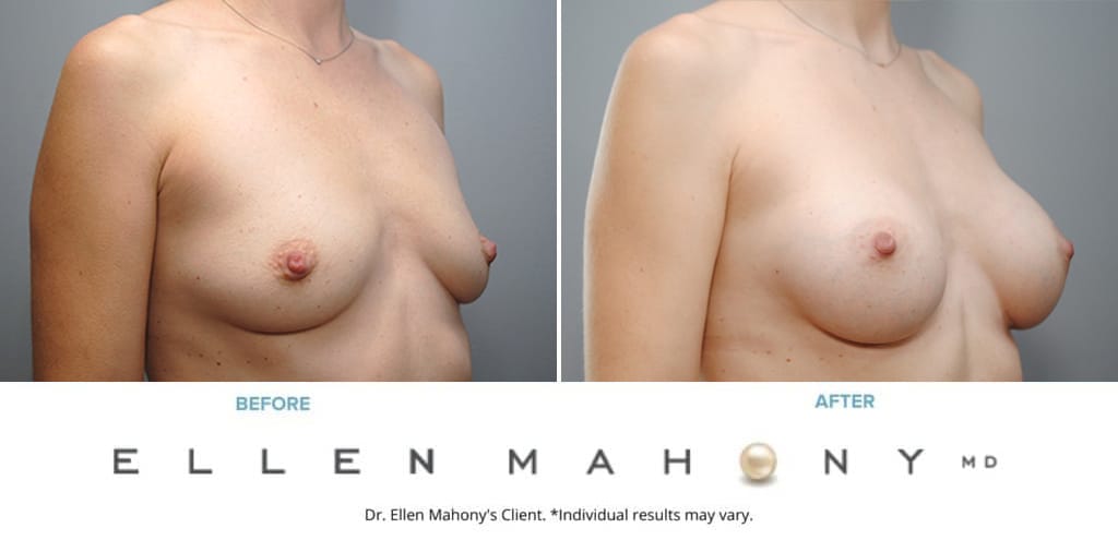 Before and After Image: Case #9316 - right-front-oblique