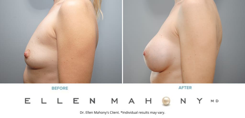 Before and After Image: Case #9316 - left-side