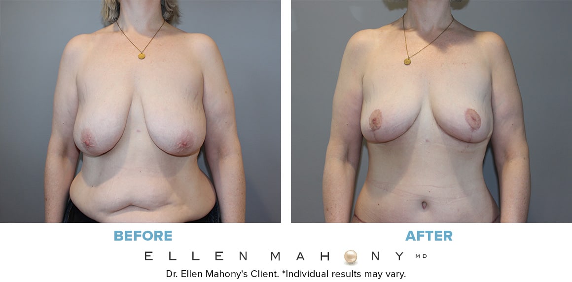 Before and After Image: Case #13364 - front