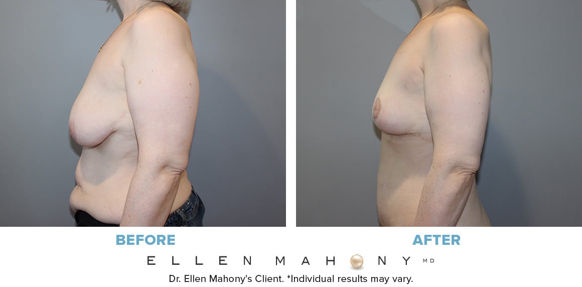 Before and After Image: Case #13364 - left-side