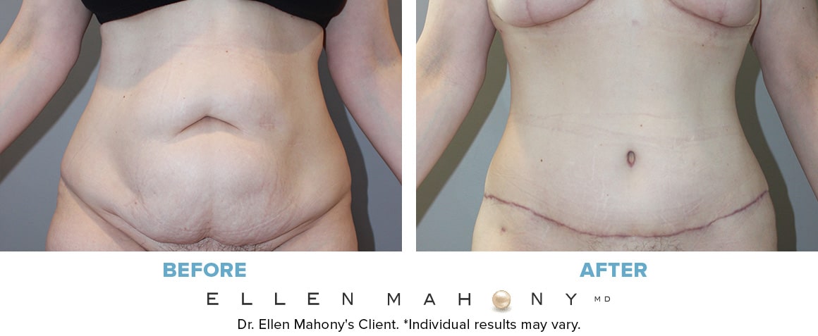 Before and After Image: Case #13364 - front