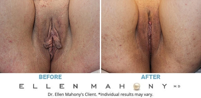 Before and After Image: Case #11743 - front