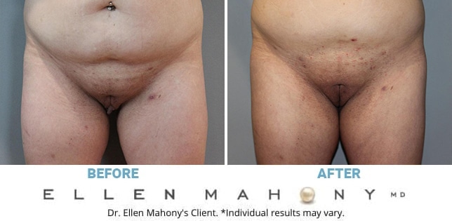 Before and After Image: Case #11743 - front
