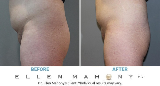 Before and After Image: Case #11743 - left-side
