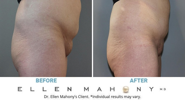 Before and After Image: Case #11743 - right-side