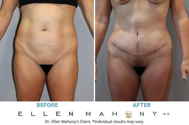 Before and After Image: Case #11015 - front