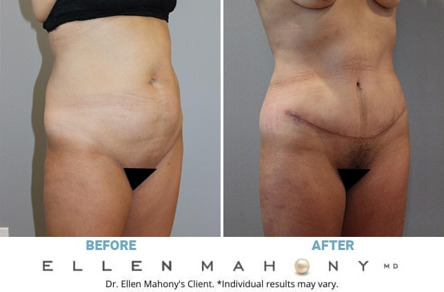 Before and After Image: Case #11015 - right-front-oblique