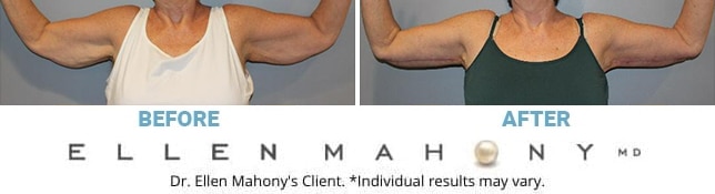 Before and After Image: Case #6526 - front