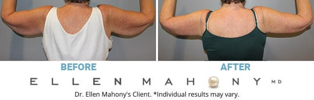 Before and After Image: Case #6526 - back