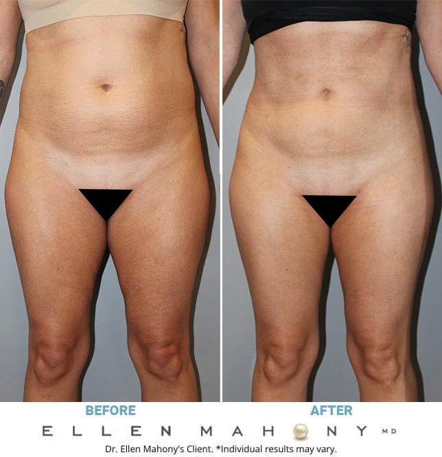Before and After Image: Case #13089 - front