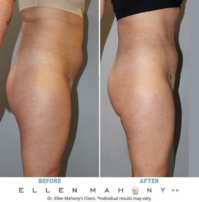 Before and After Image: Case #13089 - right-side