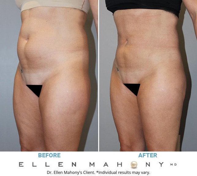 Before and After Image: Case #13089 - left-front-oblique