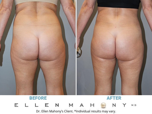 Before and After Image: Case #13089 - back