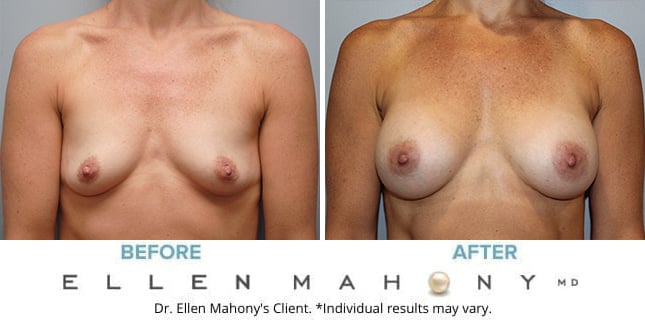 Before and After Image: Case #10000 - front