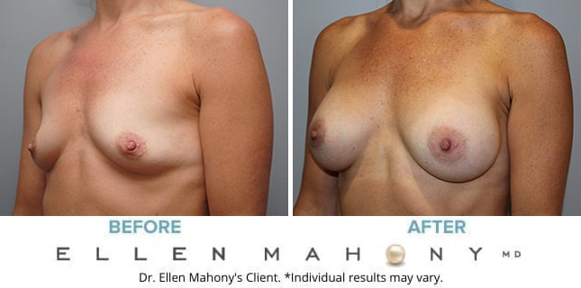Before and After Image: Case #10000 - left-front-oblique