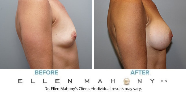 Before and After Image: Case #10000 - right-side