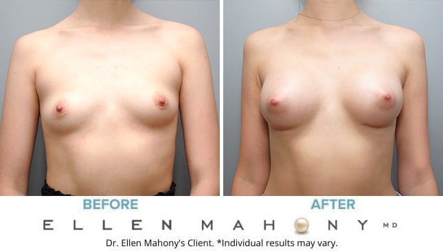 Before and After Image: Case #10005 - front