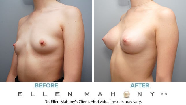 Before and After Image: Case #10005 - left-front-oblique