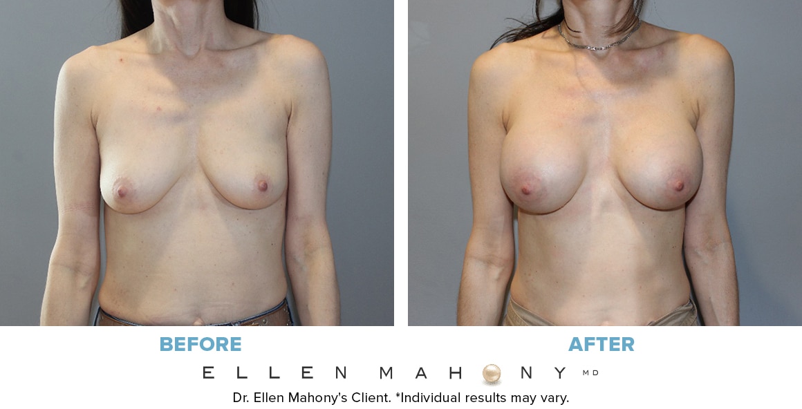 Before and After Image: Case #10097 - front