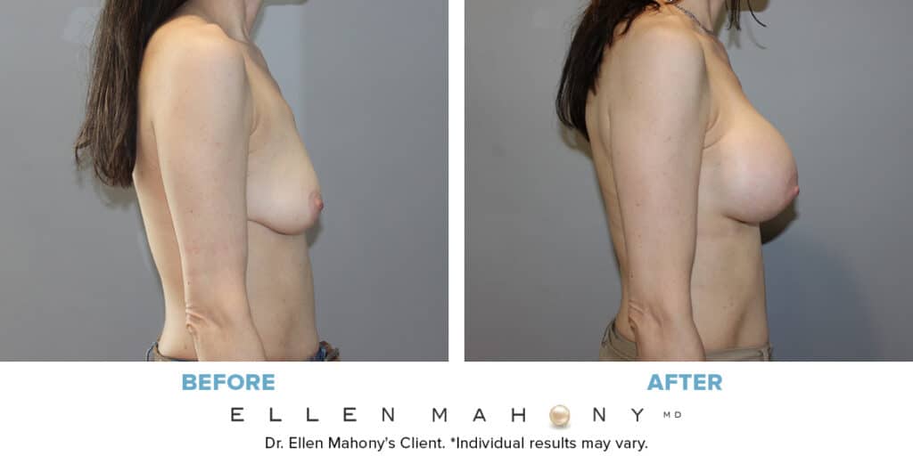 Before and After Image: Case #10097 - right-side