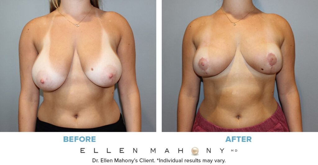 Before and After Image: Case #13297 - front