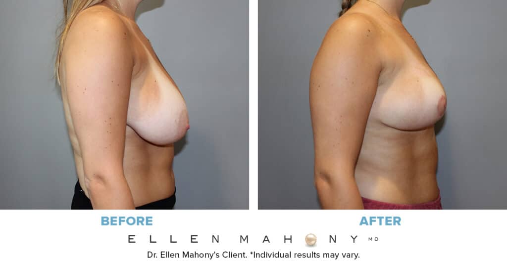 Before and After Image: Case #13297 - right-side