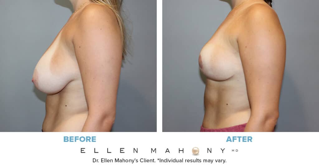 Before and After Image: Case #13297 - left-side