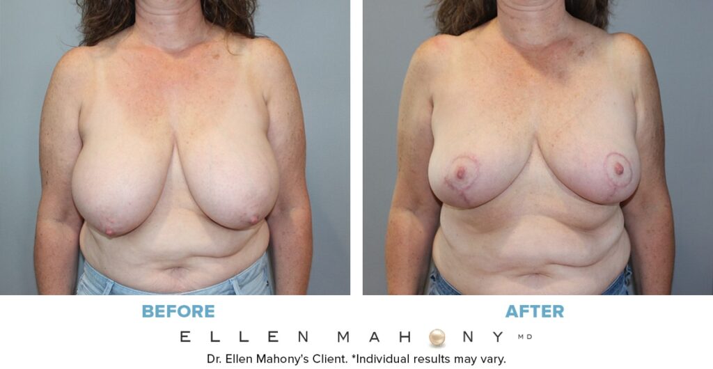 Before and After Image: Case #13671 - front