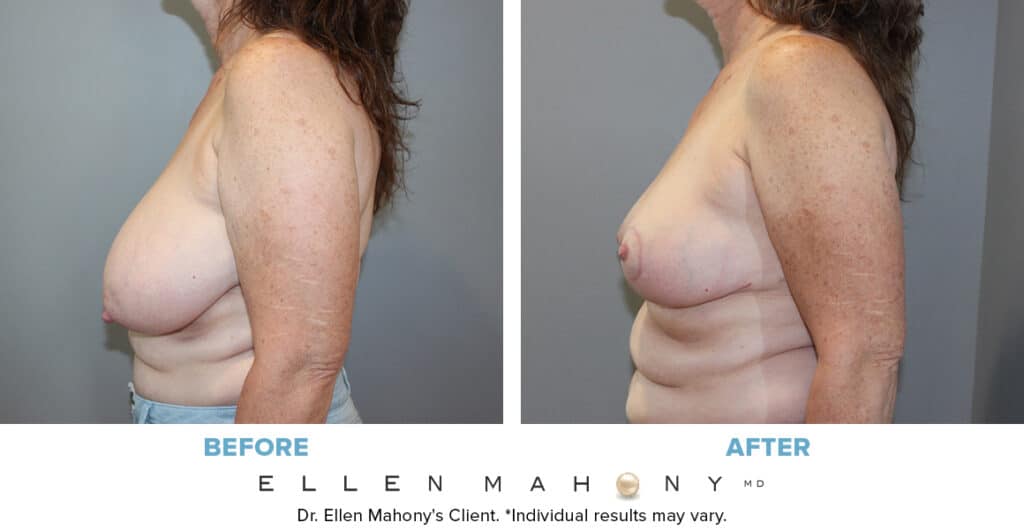 Before and After Image: Case #13671 - left-side