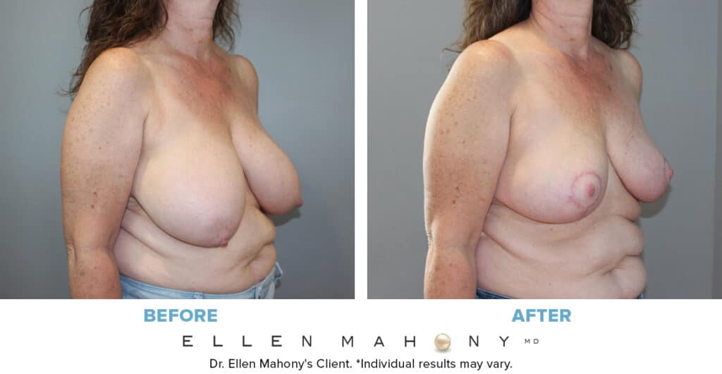 Before and After Image: Case #13671 - right-front-oblique