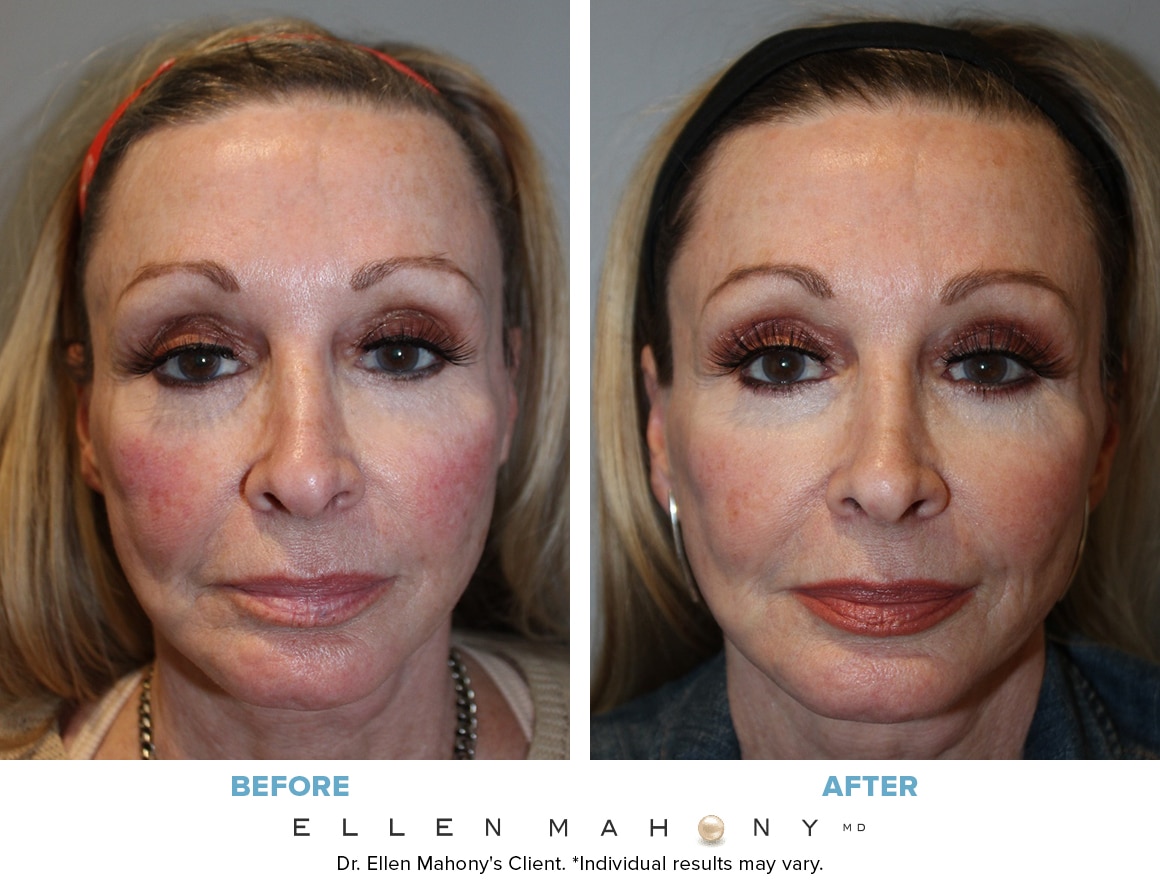 Before and After Image: Case #7724 - front