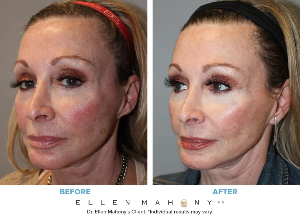 Before and After Image: Case #7724 - left-front-oblique