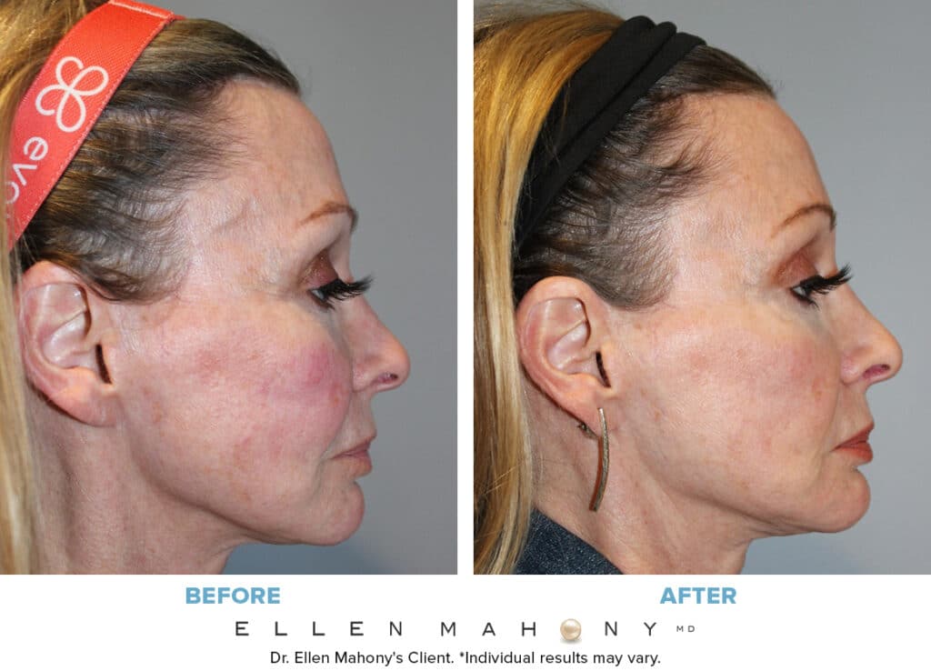 Before and After Image: Case #7724 - right-side