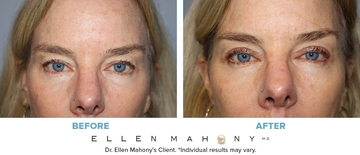 Before and After Image: Case #10500 - front