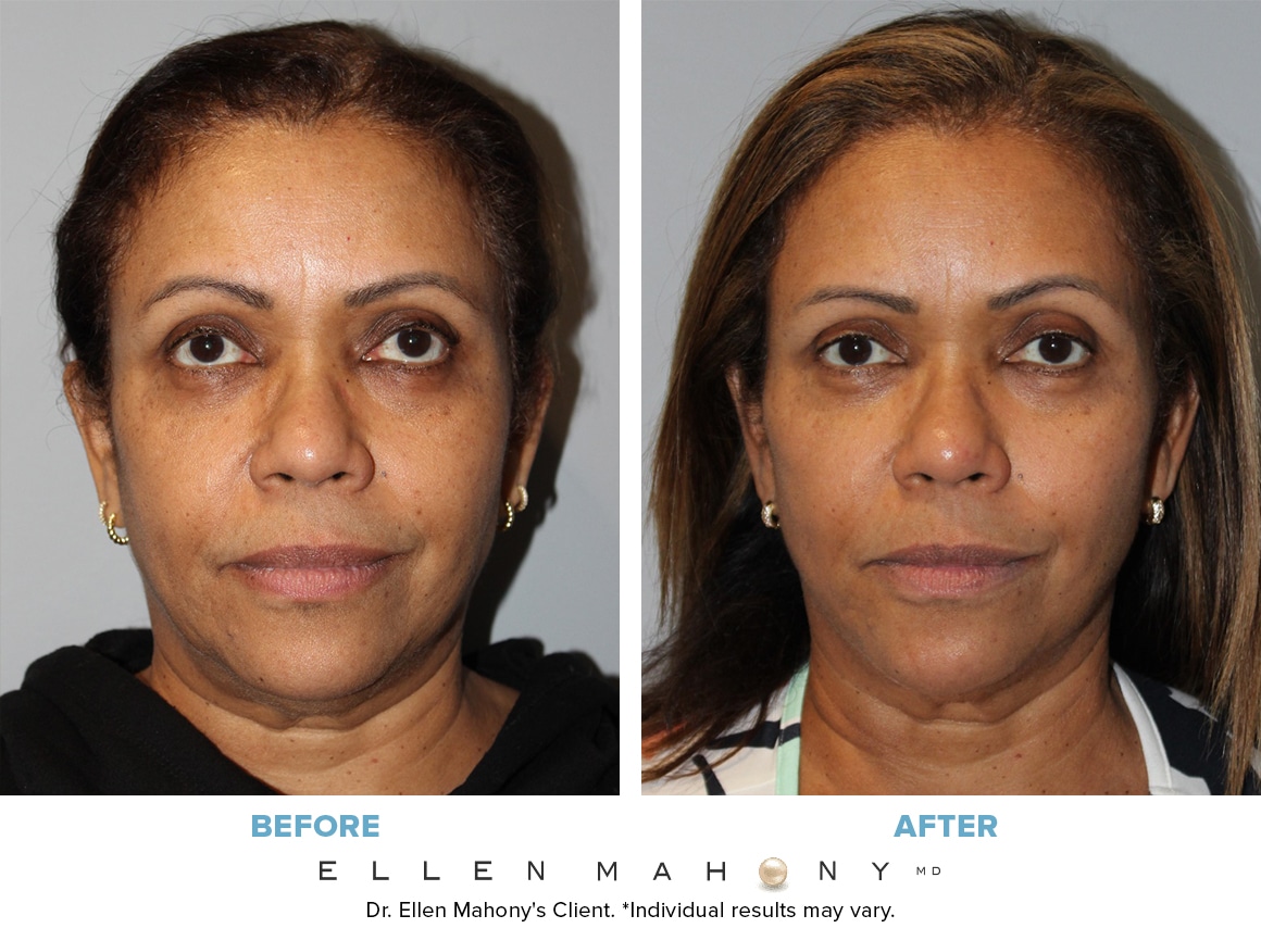 Before and After Image: Case #13599 - front