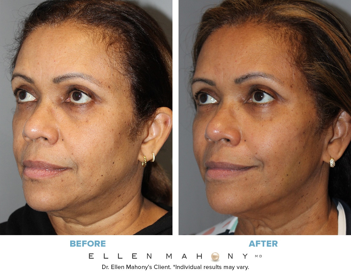 Before and After Image: Case #13599 - left-front-oblique