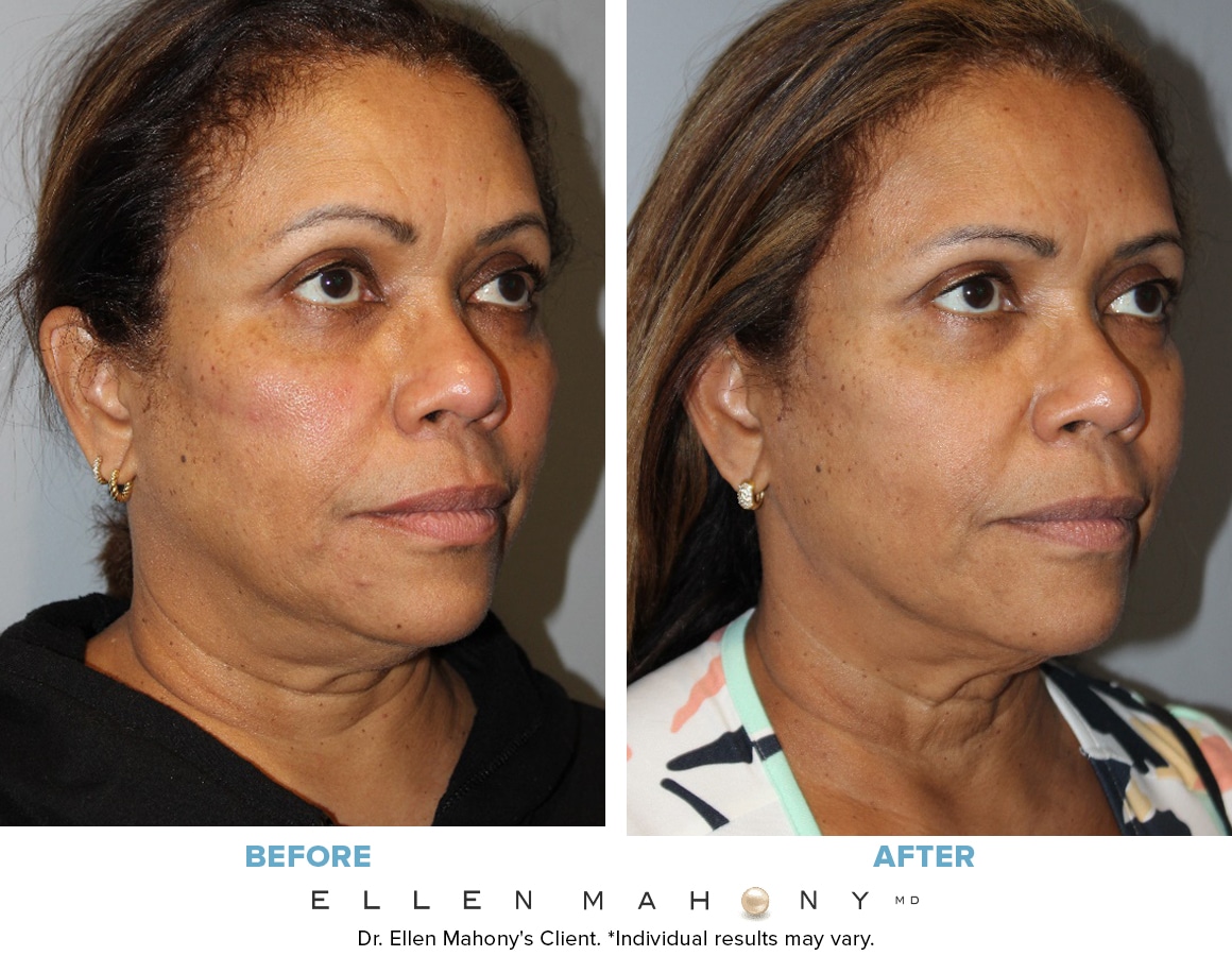 Before and After Image: Case #13599 - right-front-oblique