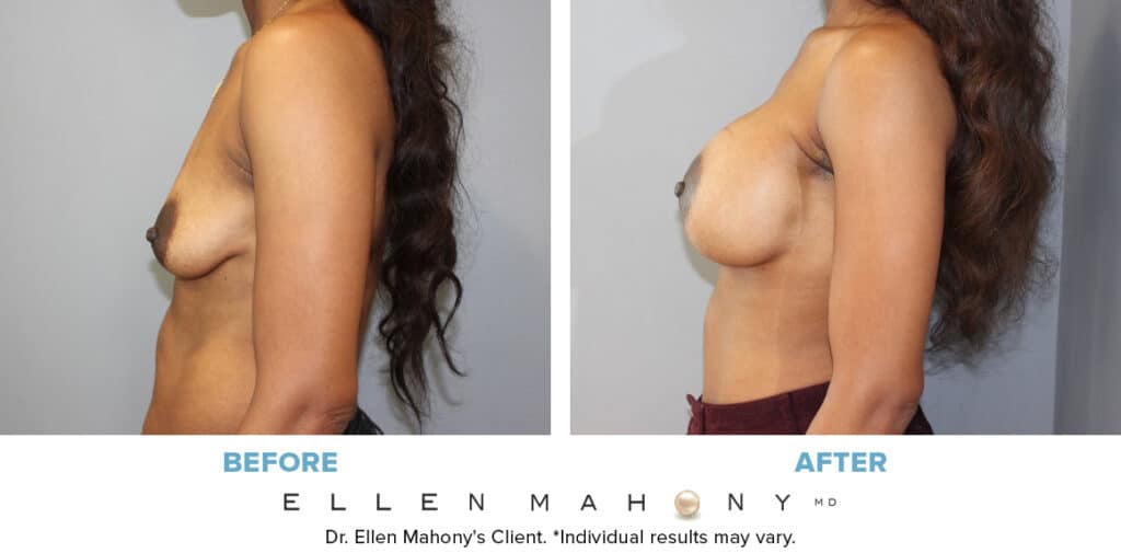 Before and After Image: Case #13696 - left-side