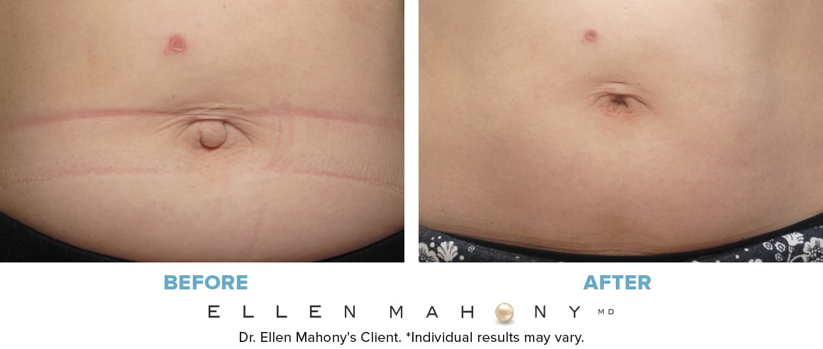 Before and After Image: Case #9561 - front