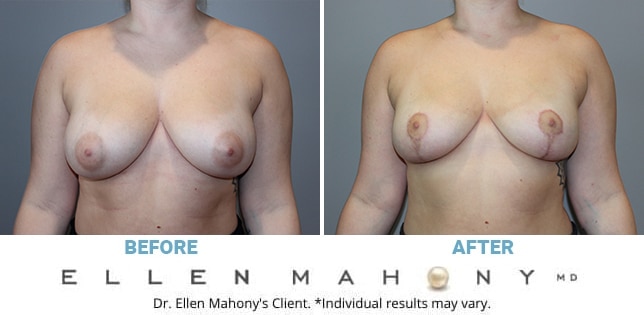Before and After Image: Case #10956 - front