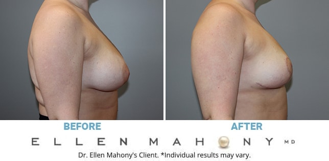 Before and After Image: Case #10956 - right-side