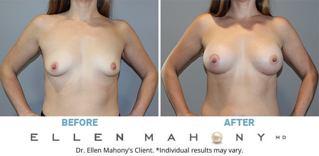 Before and After Image: Case #11021 - front