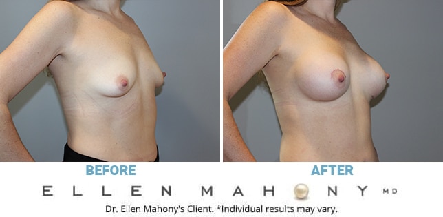 Before and After Image: Case #11021 - right-front-oblique