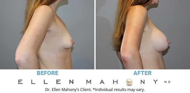Before and After Image: Case #11021 - right-side