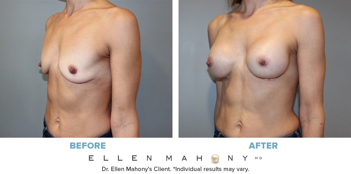 Before and After Image: Case #13048 - left-front-oblique
