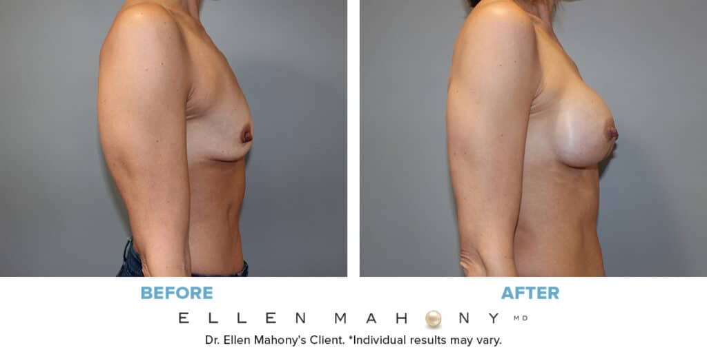 Before and After Image: Case #13048 - right-side
