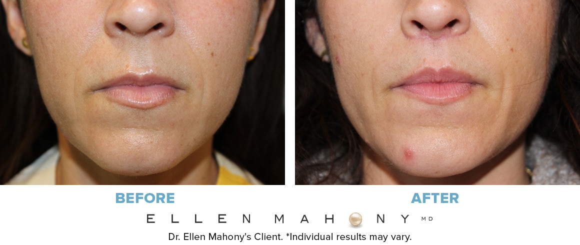 Before and After Image: Case #13676 - front