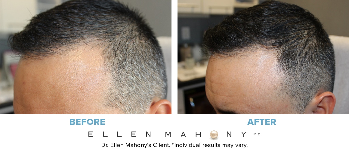 Before and After Image: Case #14030 - left-front-oblique