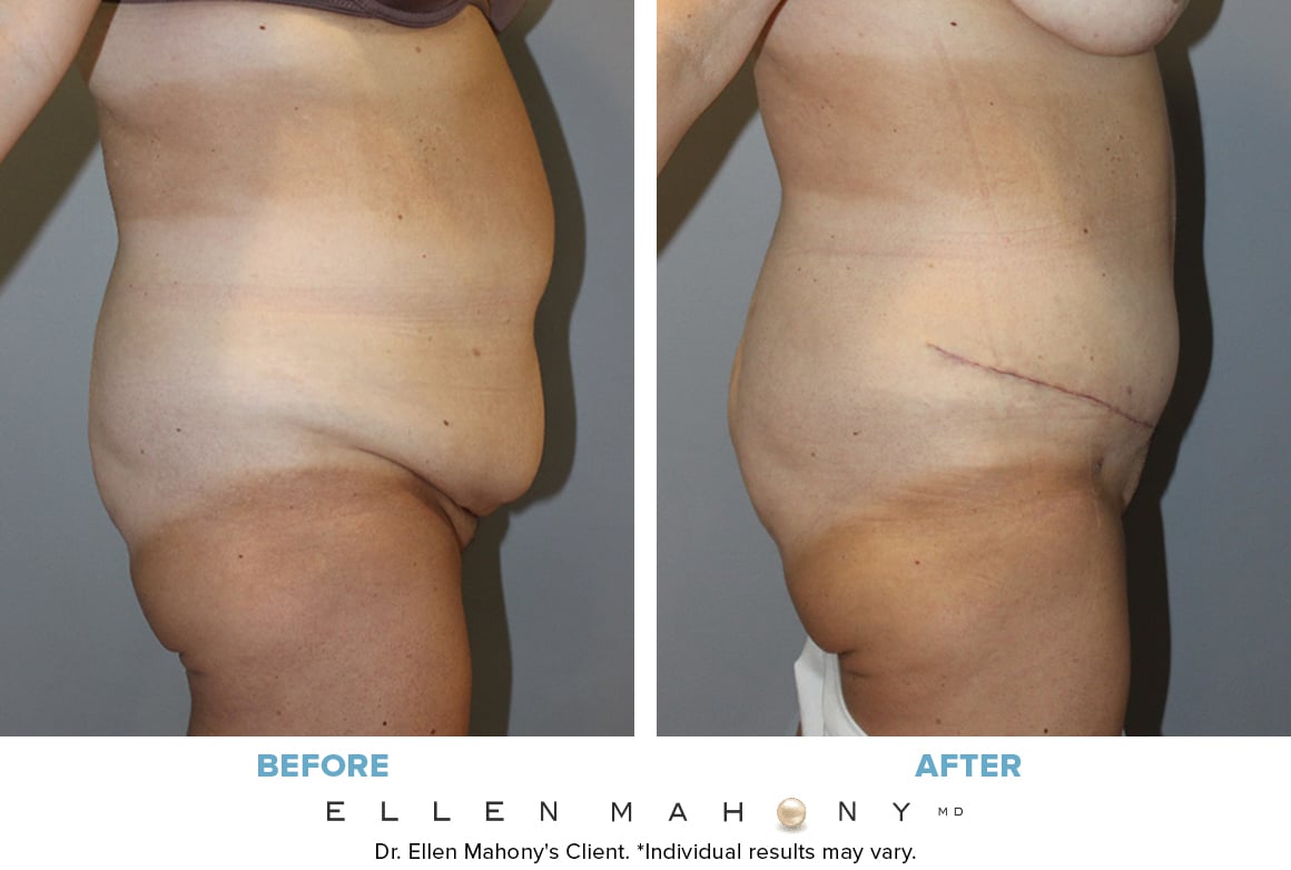 Before and After Image: Case #6582 - right-side