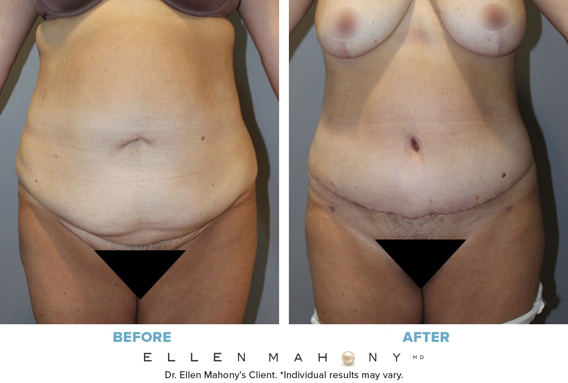 Before and After Image: Case #6582 - front
